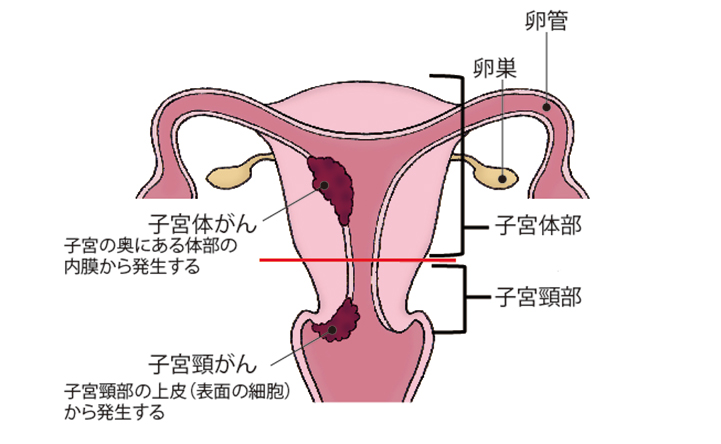 (図)「子宮頸がんと子宮体がんの発生する場所」
