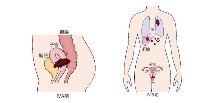 図）「子宮頸がんの進行期分類」