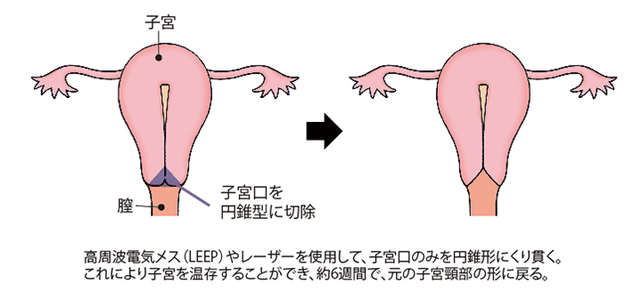 （図）「子宮頸部円錐切除術」