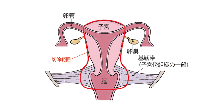 （図）「準広汎子宮全摘術」