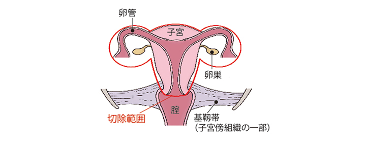 （図）「単純子宮全摘術+両側付属器切除術」