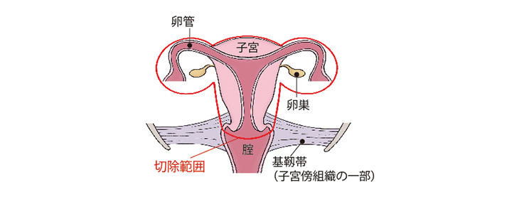 （図）「準広汎子宮全摘術+両側付属器切除術」