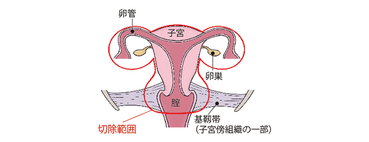 （図）「広汎子宮全摘術+両側付属器切除術」