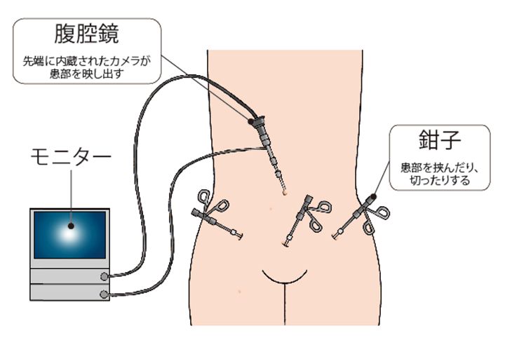 （図）「腹腔鏡下手術」