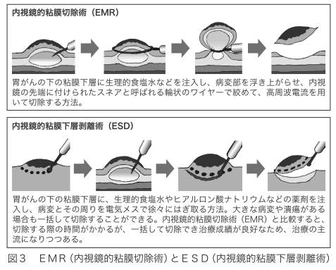 胃がんのEMR/ESD