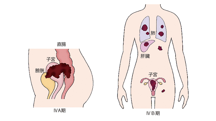 図）「子宮体がんの進行期分類」