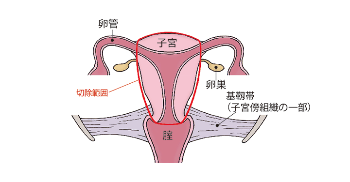 （図）「単純子宮全摘術」