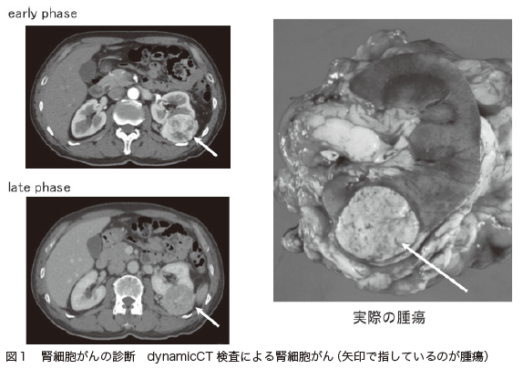 図１　腎細胞がんの診断　dynamicCT検査による腎細胞がん（矢印で指しているのが腫瘍）[第8回　がん治療（標準治療）の基礎知識　腎臓がん]