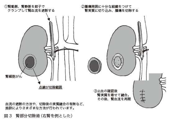 図３　腎部分切除術（右腎を例とした）[第8回　がん治療（標準治療）の基礎知識　腎臓がん]