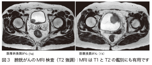 図3　膀胱がんのMRI 検査（T2 強調）：MRI はT1とT2 の鑑別にも有用です[第9回　がん治療（標準治療）の基礎知識　膀胱がん]