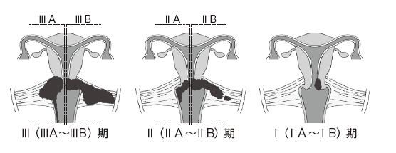 図２　子宮頸がんの臨床進行期分類
Ⅰ（ⅠA ～ⅠB）期
Ⅱ（ⅡA ～ⅡB）期
Ⅲ（ⅢＡ～ⅢＢ）期
