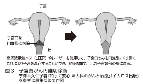 図３　子宮頸がん円錐切除術　宇津木久仁子著『知って安心 婦人科のがんと治療』（イカロス出版）を参考に編集部にて作図
高周波電気メス（LEEP）やレーザーを使用して、子宮口のみを円錐型にくり貫く。
これにより子宮を温存することができ、約６週間で、元の子宮頸部の形に戻る。
