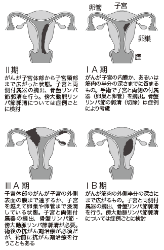 図4　子宮体がんの進行期分類
[ⅠＡ期]
がんが子宮の内膜か、あるいは筋肉の半分の深さまでに留まるもの。手術で子宮と両側の付属器（卵巣と卵管）を摘出。骨盤リンパ節の郭清（切除）は症例により考慮

[ⅠＢ期]
がんが筋肉の外側半分の深さにまで広がるもの。子宮と両側付属器の摘出、骨盤リンパ節郭清を行う。傍大動脈リンパ節郭清については症例ごとに検討

[Ⅱ期]
がんが子宮体部から子宮頸部まで広がった状態。子宮と両側付属器の摘出、骨盤リンパ節郭清を行う。傍大動脈リンパ節郭清については症例ごとに検討

[ⅢＡ期]
子宮体部のがんが子宮の外側表面の膜まで達するか、子宮を越えて卵巣や卵管まで浸潤している状態。子宮と両側付属器の摘出、骨盤リンパ節・傍大動脈リンパ節郭清が必要。術後の抗がん剤治療が必須だが、術前に抗がん剤治療を行うこともある

