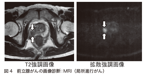 図4　前立腺がんの画像診断：MRI（局所進行がん）
左側：T2強調画像
右側：拡散強調画像