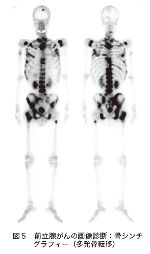 図５　前立腺がんの画像診断：骨シンチグラフィー（多発骨転移）
