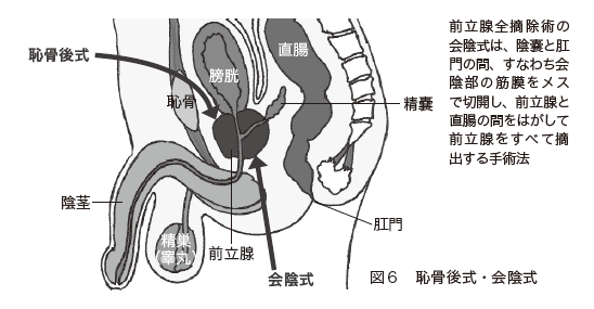図６　恥骨後式・会陰式

前立腺全摘除術の会陰式は、陰嚢と肛門の間、すなわち会陰部の筋膜をメスで切開し、前立腺と直腸の間をはがして前立腺をすべて摘出する手術法