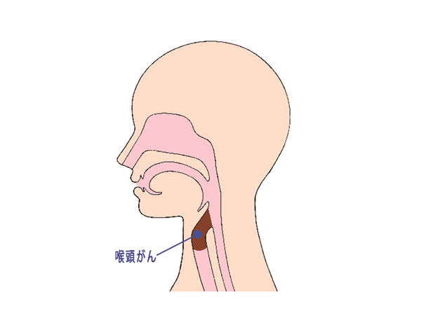 喉頭がんの位置