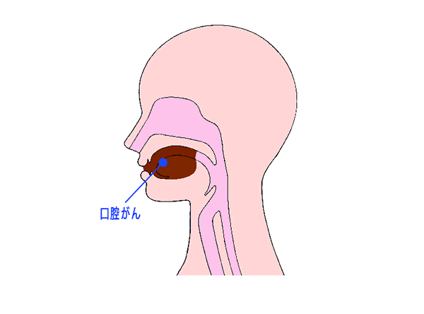 口腔がんの位置