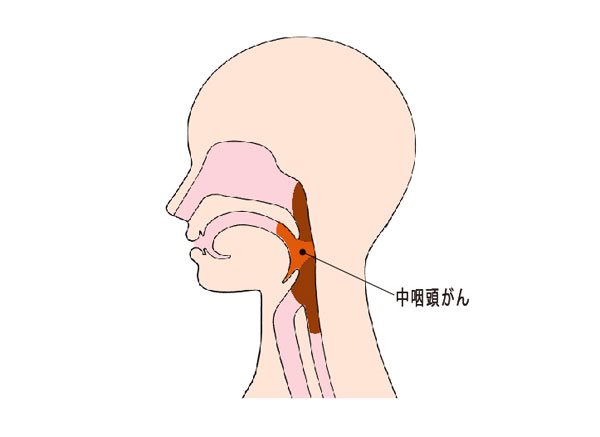 （図）中咽頭がんの位置