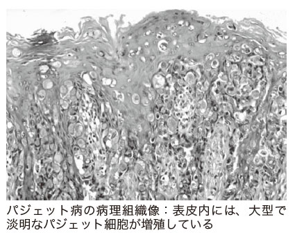 パジェット病の病理組織像：表皮内には、大型で淡明なパジェット細胞が増殖している