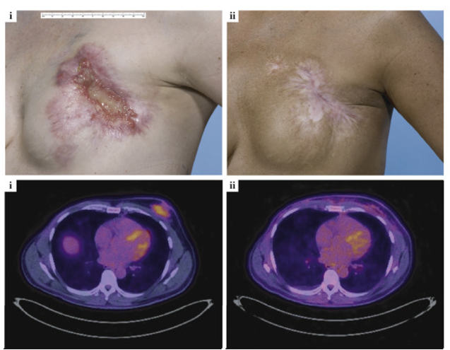 図３　コータックによる局所進行乳がんの治療。左が治療前、右が治療後