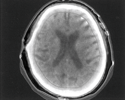 写真④　頭皮血管肉腫の線量分布