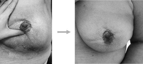 写真２　乳房温存術後オイル使用　毛穴の目立ちもなくなり、乾燥も非常に改善。回復が早い皮膚も滑らかになった