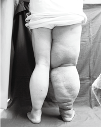 写真1　子宮がん術後右下肢リンパ浮腫