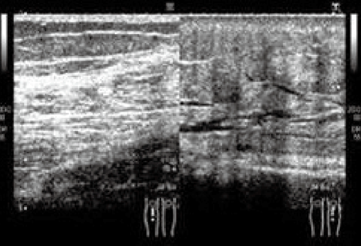 写真3　3期のエコー所見（左側が患肢）