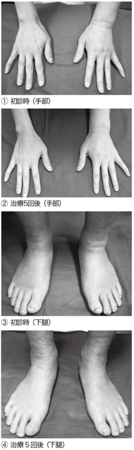 写真５　治療例：乳がん治療に伴う強皮症様皮膚硬化（患側上肢、両下肢に発症）