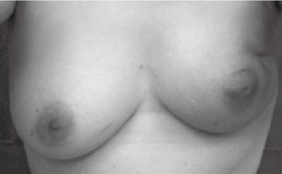 写真１　乳房の浮腫、慢性的な熱感（左側）