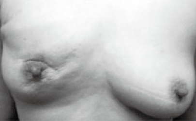 写真2　乳房の皮膚硬化（右側）