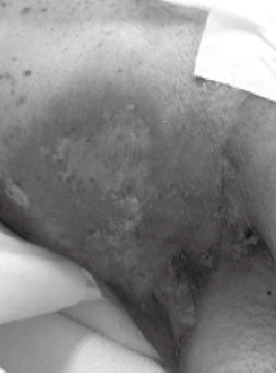 写真5　放射線による皮膚線維症（腋窩）