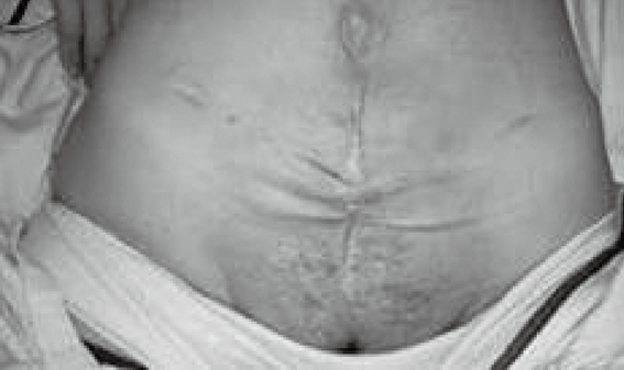 写真1　子宮がん術後・照射後　下腹部リンパ浮腫