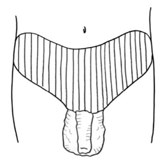 図3　下腹部パット(手製)とチューブ包帯による圧迫
