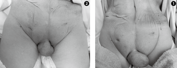 写真4　前立腺がん術後・照射後　下腹部リンパ浮腫　①治療前　②治療後