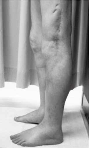 写真1　大腿骨骨折後の外傷性浮腫 浮腫発症から1年後に来室（受傷部から足部にかけて慢性化した浮腫）