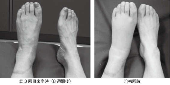写真３　左アキレス腱断裂後の外傷性浮腫の治療効果
