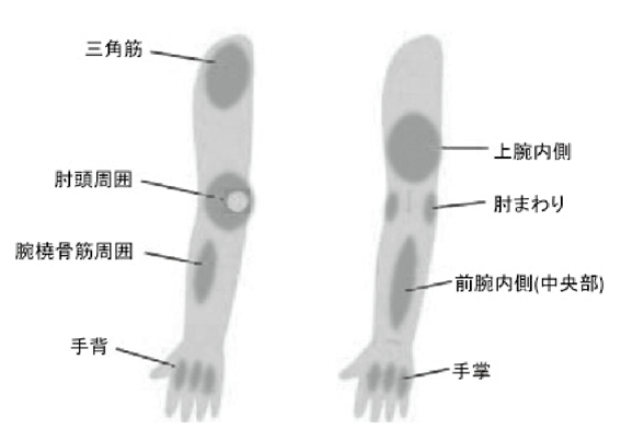 図1　線維化の好発部位（上肢）