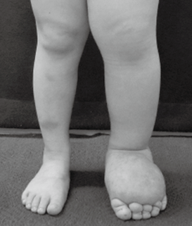 写真１　先天性下肢リンパ浮腫（小児）