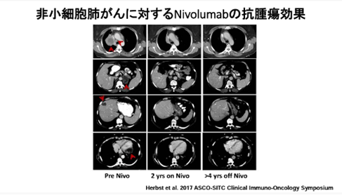 写真２　非小細胞肺がんに対するニボルマブ（オプジーボ）の抗腫瘍効果※3：Herbst et al. 2017 ASCO-SITC Clinical Immuno-Oncology Symp